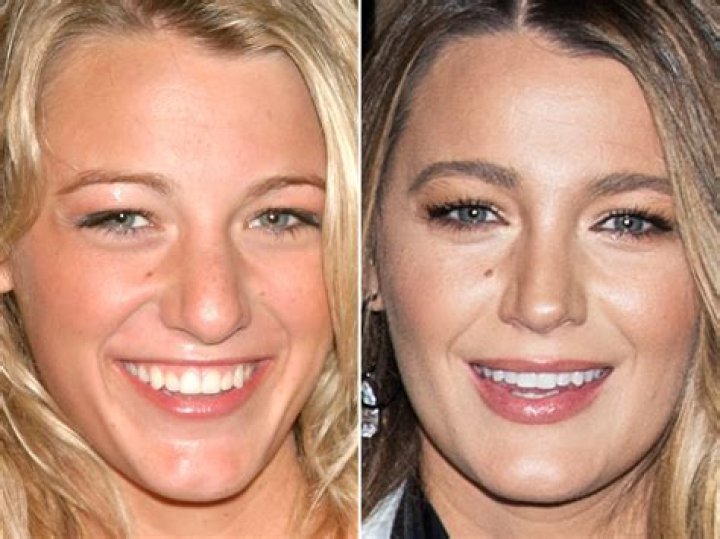 Blake Lively's Transformation: Before And After Her Alleged Nose Job